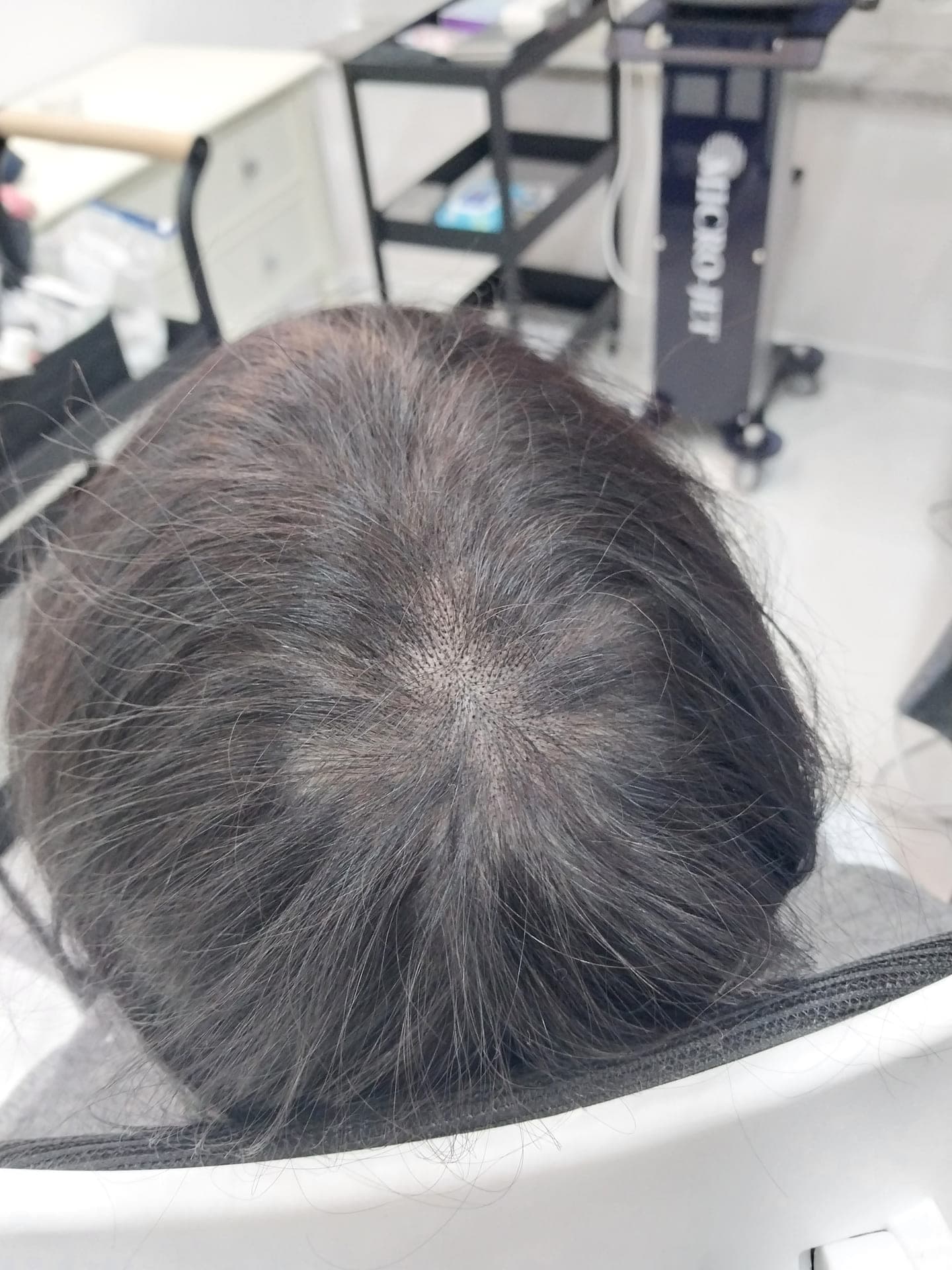 Scalp Micropigmentation — After