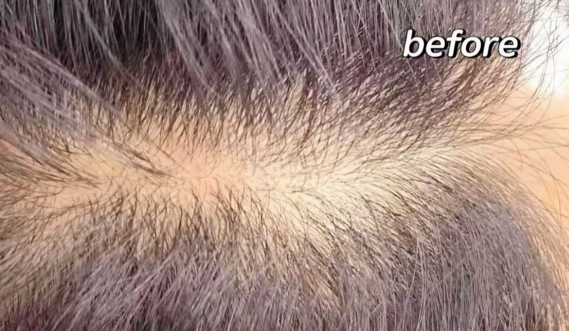 Scalp Micropigmentation — Before